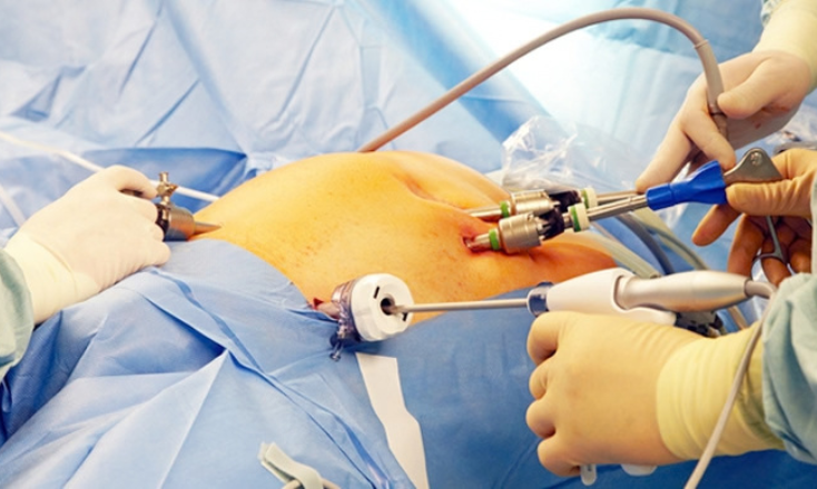 Advanced Laparoscopic Surgery